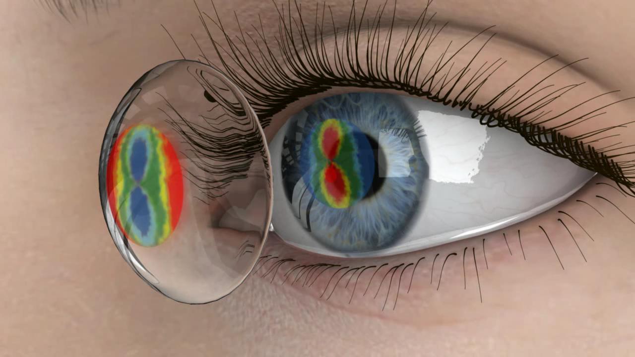 Soft Contacts for Astigmatism EYETECH