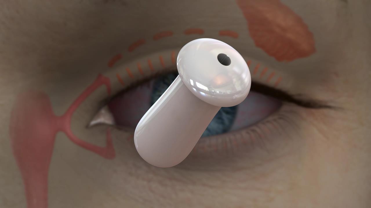 Punctal Plugs preserve tears in aqueous deficieny dry eyes