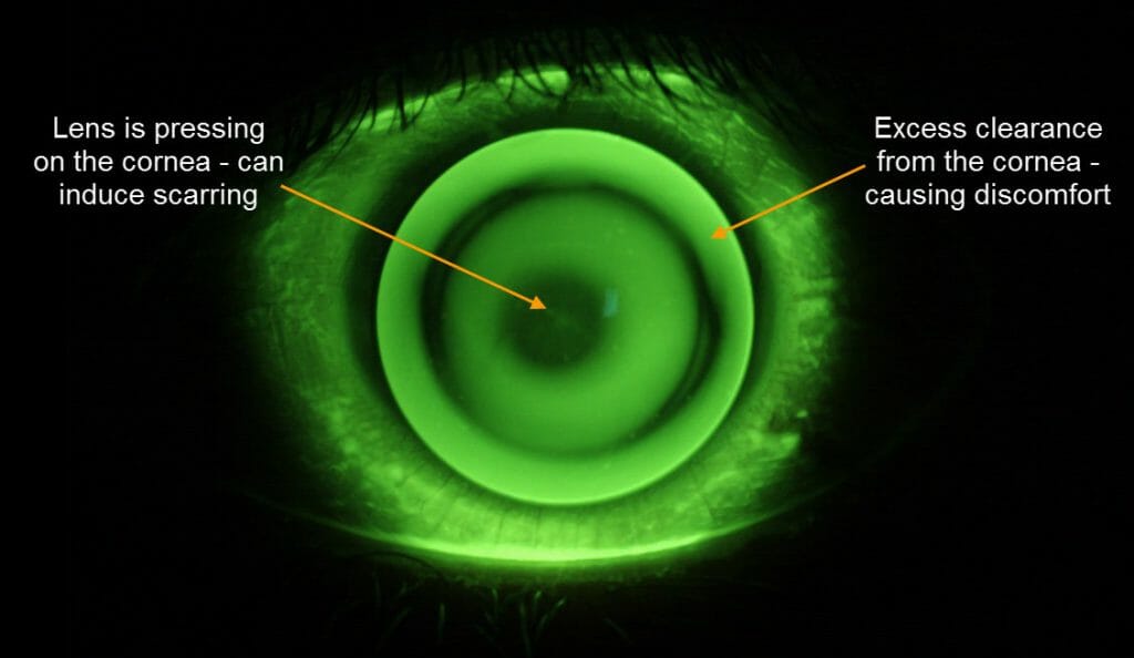 Scleral Lenses Customised Keratoconus Lens Fitting Eyetech