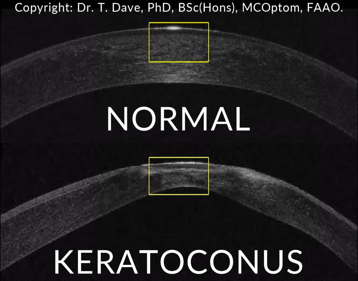 keratoconus